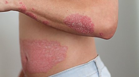 An image of a man with psoriasis on the arm and abdomen.