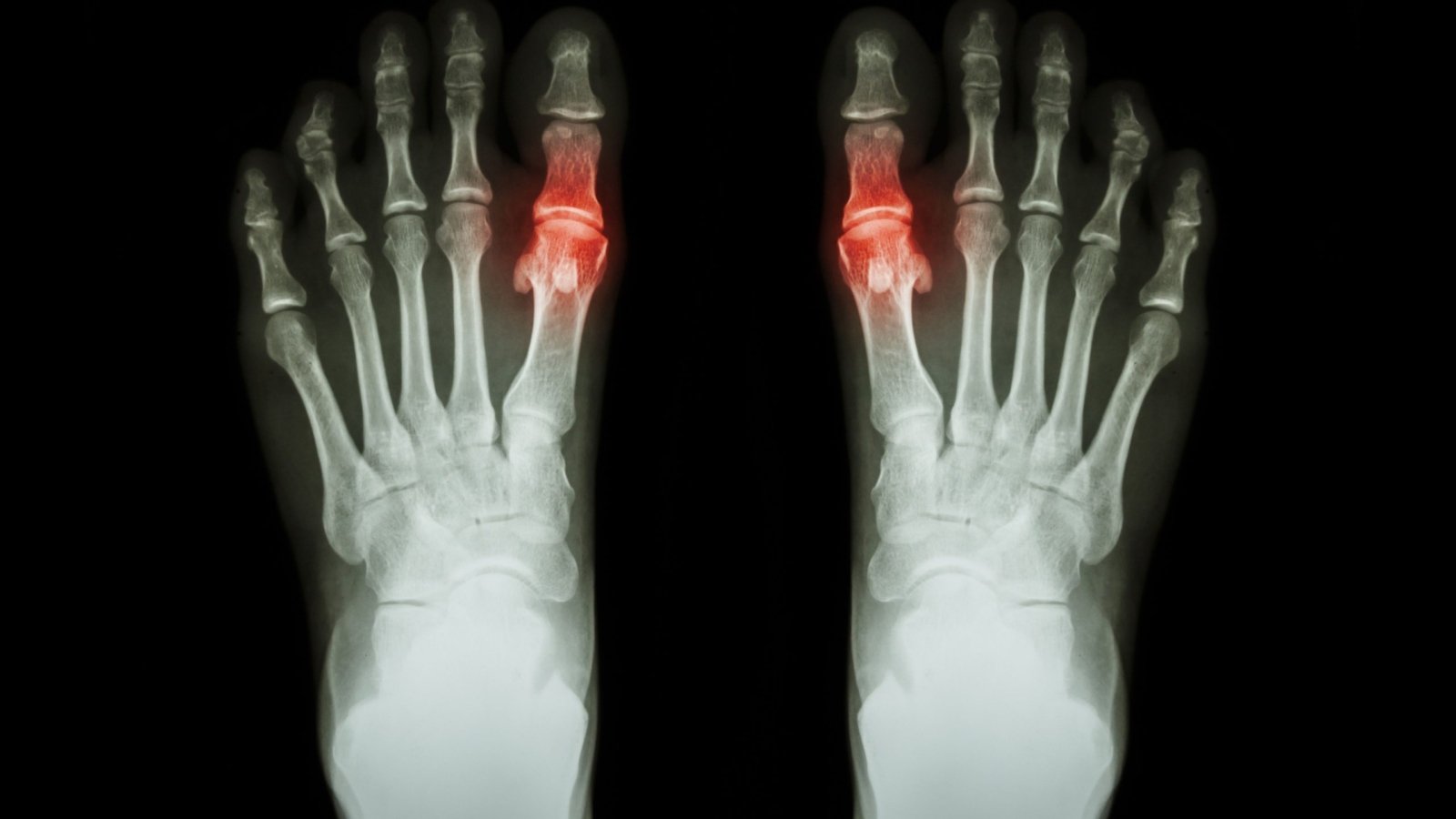 An imaging showing human hands afflicted with Rheumatoid arthritis.