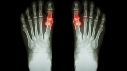 An imaging showing human hands afflicted with Rheumatoid arthritis.