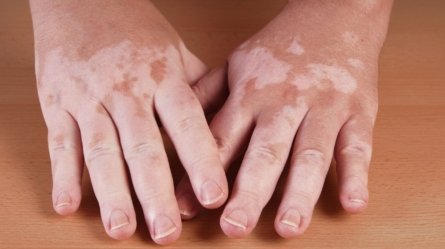 An image of human hands affected with vitiligo.