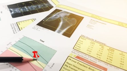 An image of the scan results for bone mineral density test.