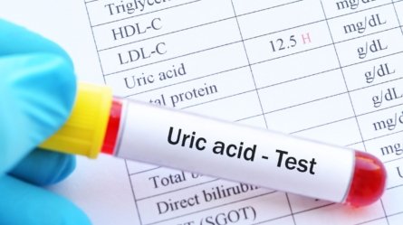 Blood sample tube with a report showing abnormally high levels of uric acid.