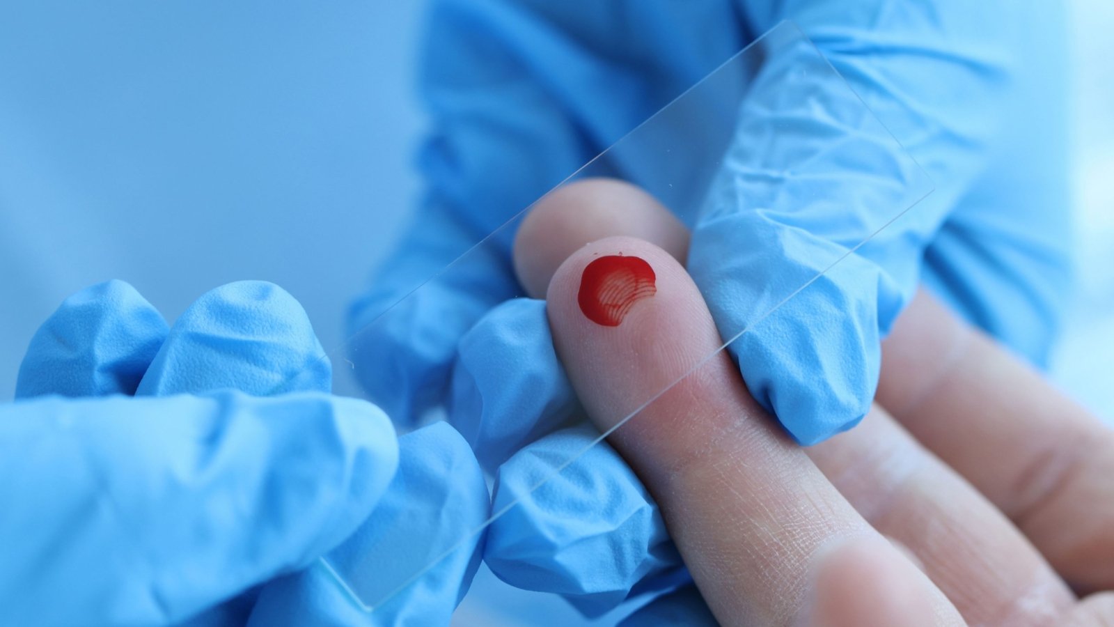 A blood sample is taken to know hemoglobin levels.